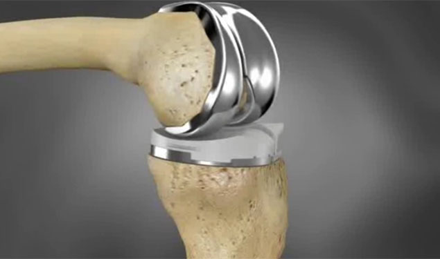 Knee Surgery