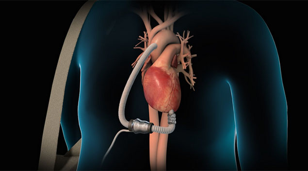 Bionic Heart