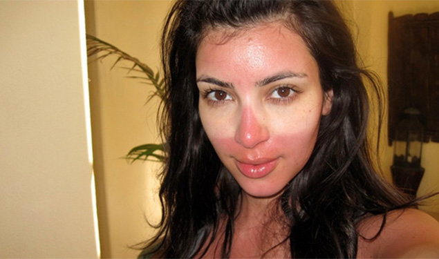 sunburn