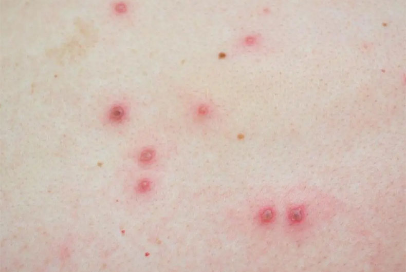 Monkeypox outbreak
