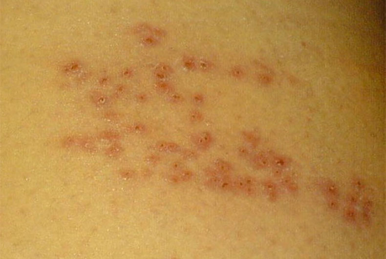 Canada Monkeypox