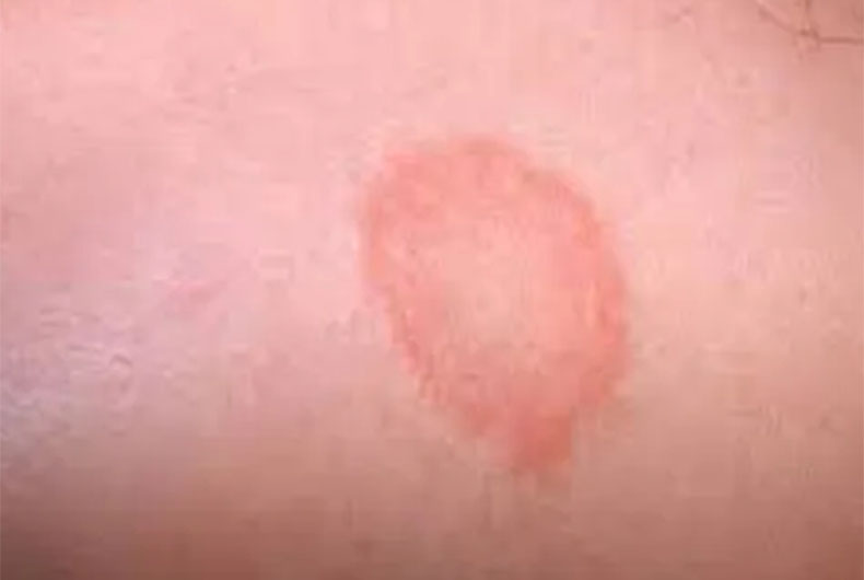 Aregntina Monkeypox