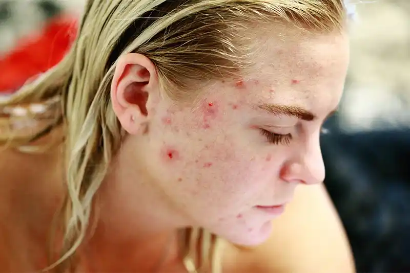 Acne: Symptoms, Types and Treatment from Unani Medications